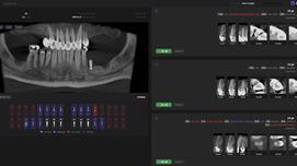 בינה מלאכותית ככלי-עזר לפיענוח איכותי יותר של CT דנטלי – Diagnocat
